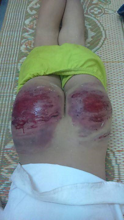 Thái Nguyên: Bố đánh con trai 13 tuổi bầm mông, rướm máu phải nhập viện - Ảnh 2.
