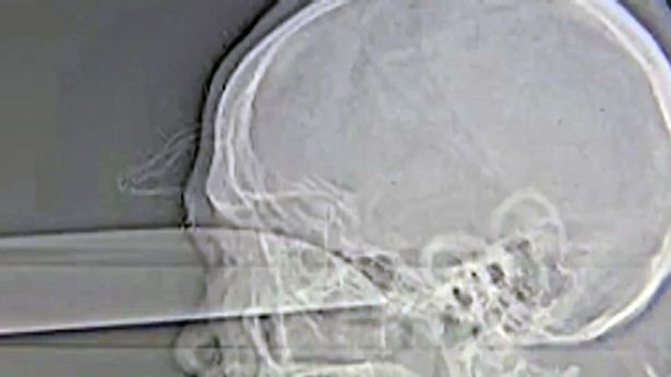 Colombia: Sống sót ngoạn mục sau khi bị đâm xuyên mắt thủng não - Ảnh 1.
