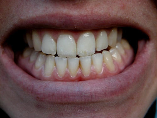 9 thói quen đang phá hỏng răng của bạn mỗi ngày - Ảnh 4.