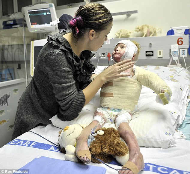 Đức: Ghép da cứu em bé mắc bệnh ly thượng bì bóng nước - Ảnh 1.
