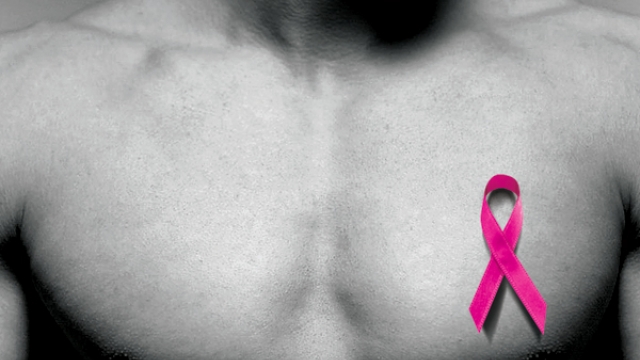 Ung thư vú ở nam giới và những điều có thể bạn chưa biết - Ảnh 1.