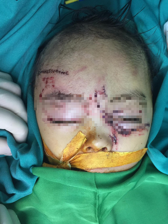 Hãi hùng: Bé gái 31 tháng tuổi bị chó nhà cắn nát mặt - Ảnh 2.