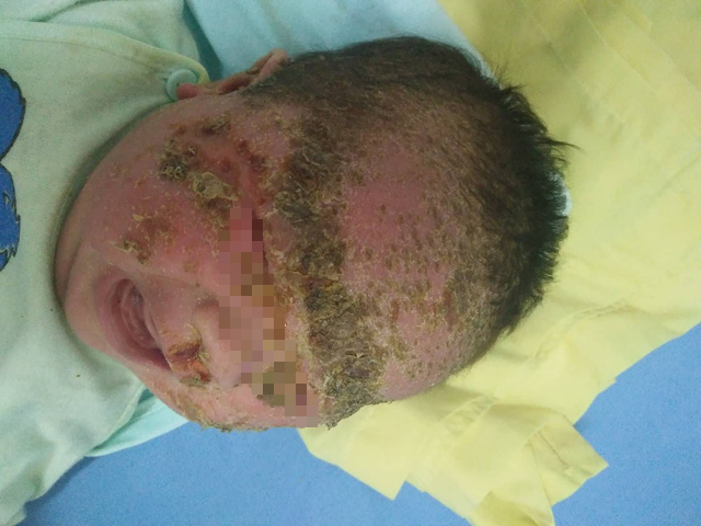 Trẻ 1 tháng tuổi viêm da chảy mủ toàn thân do tắm lá cây - Ảnh 1.