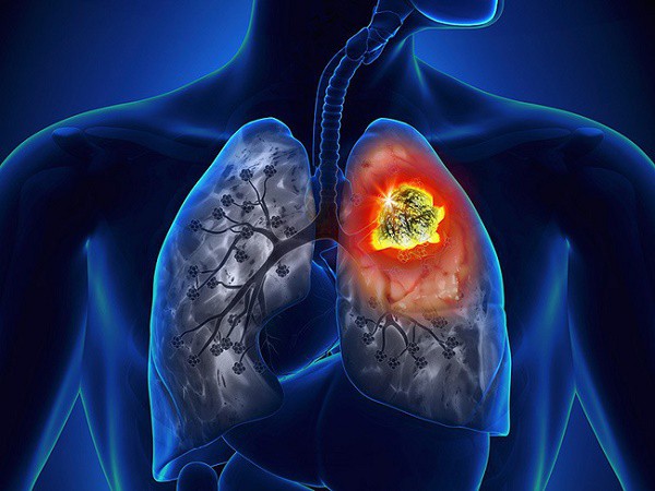 Những điều cần biết về bệnh ung thư phổi - Ảnh 1.