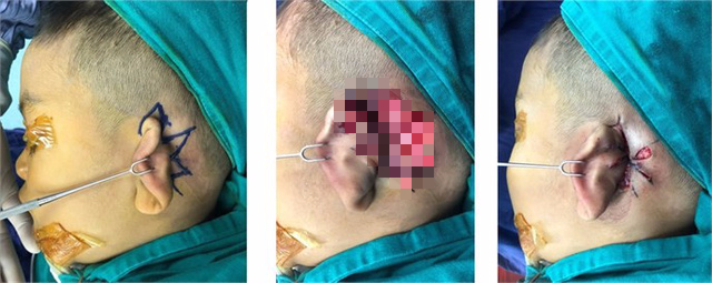 Trẻ sinh ra có vành tai bị vùi lấp được phẫu thuật tạo hình thành công - Ảnh 2.