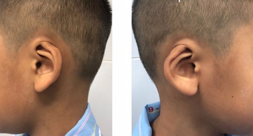Trẻ sinh ra có vành tai bị vùi lấp được phẫu thuật tạo hình thành công - Ảnh 1.