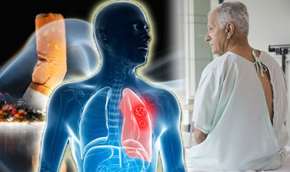 Tiết lộ 5 sự thật ít biết về ung thư phổi - Ảnh 1.