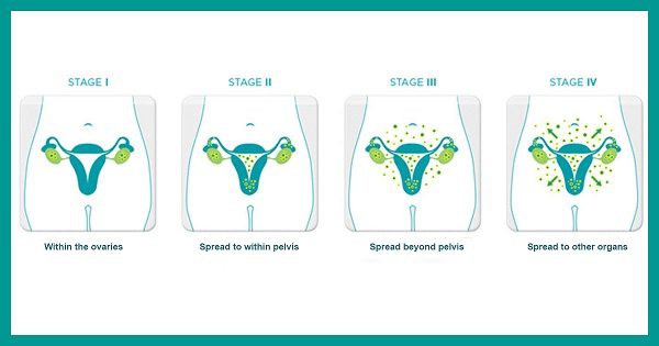 Các giai đoạn và cách điều trị ung thư buồng trứng - Ảnh 2.