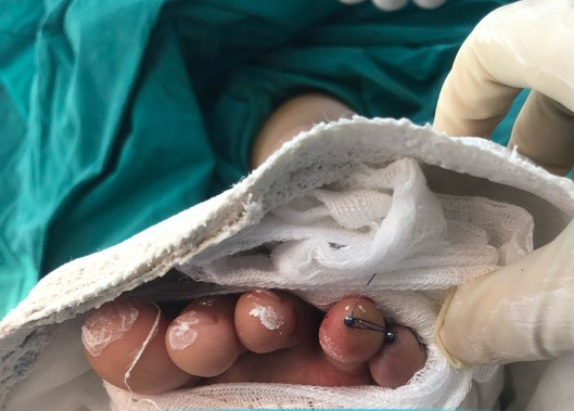 Cứu bé trai 6 tuổi bị tấm ốp inox tự chế ở xe máy cắt gần cụt ngón chân - Ảnh 1.