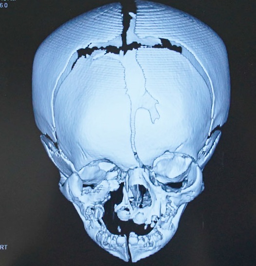 Bé sơ sinh 17 ngày tuổi có khe hở sọ mặt phức tạp rất hiếm gặp, gây biến dạng hoàn toàn 1 nửa khuôn mặt - Ảnh 1.