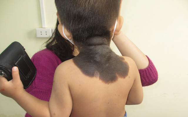 Phẫu thuật tạo hình cho bé trai 2 tuổi mắc hắc tố bẩm sinh khổng lồ vùng lưng, gáy - Ảnh 1.
