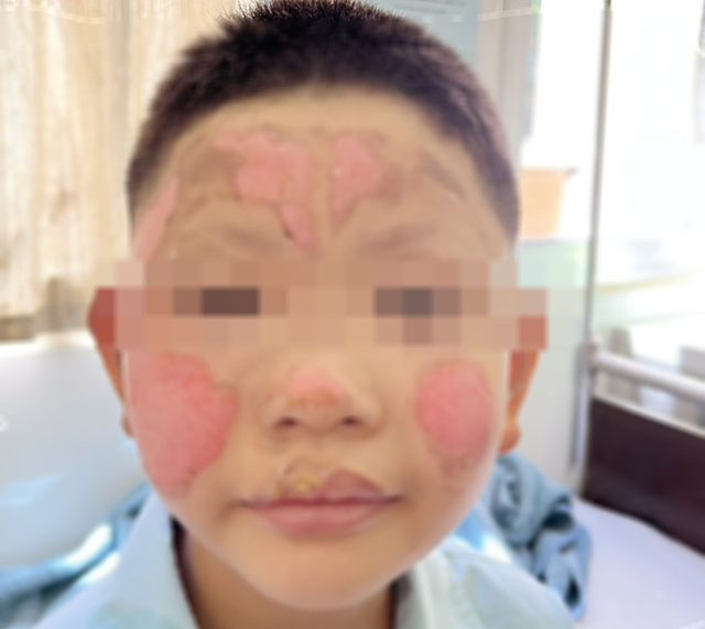 Nghịch bật lửa, bé trai 8 tuổi bị bỏng vùng mặt - Ảnh 1.