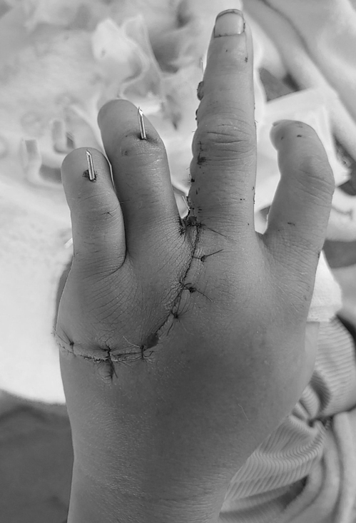 Trả lại bàn tay lành lặn cho bệnh nhân bị đứt lìa 2 ngón tay - Ảnh 1.