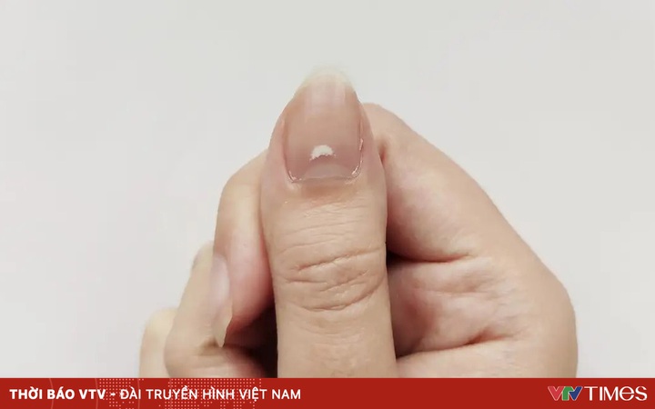 White spots on nails are a sign of these 5 health problems