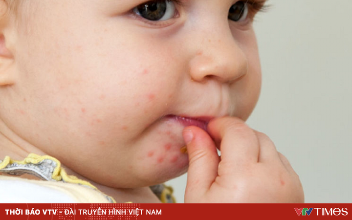 Hand, foot and mouth disease: Causes, symptoms and prevention measures