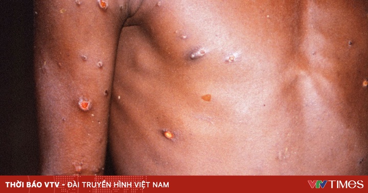 4 more rare cases of monkeypox confirmed in UK