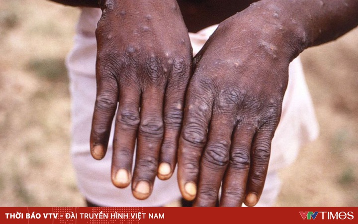 US confirms first case of monkeypox in 2022 in Massachusetts