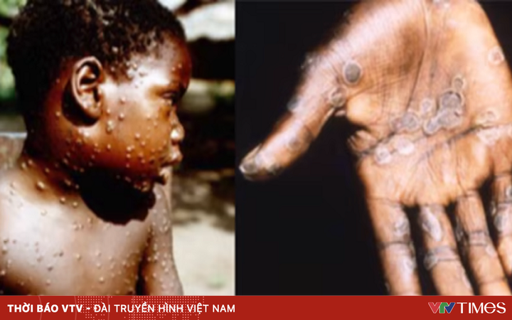 Canada confirms first two cases of monkeypox