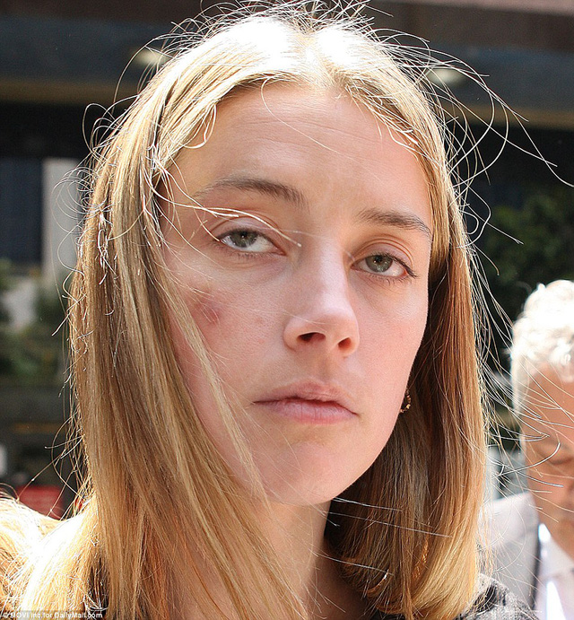 
Amber Heard với vết bầm trên mặt. Đây được cho là dấu vết của chiếc iPhone do Johnny ném vào cô, một hành vi mà theo cáo buộc của Amber là bạo lực và hành hung. (Ảnh: Daily Mail)
