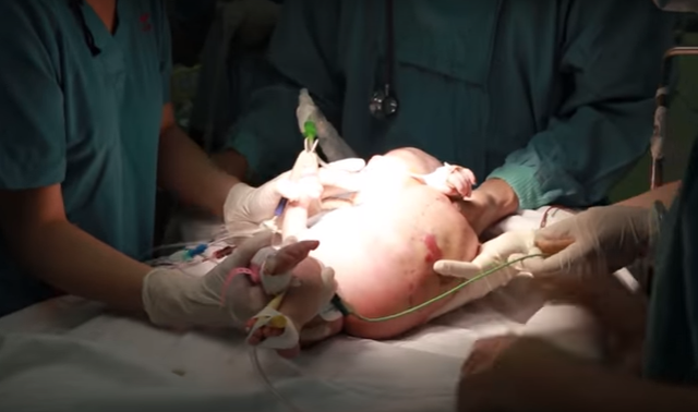 Phẫu thuật thành công khối bướu khổng lồ trên cơ thể trẻ sơ sinh - Ảnh 2.
