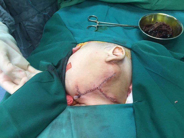 Cắt bỏ thành công khối u lớn vùng mặt cho bé gái 8 tháng tuổi - Ảnh 2.
