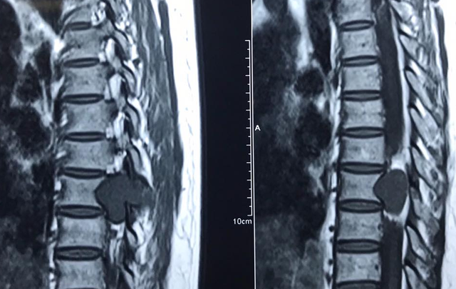 U tủy sống chèn ép dây thần kinh gây liệt hai chân - Ảnh 1.