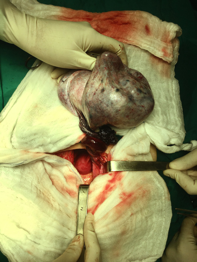 TP.HCM: Phẫu thuật thành công cho bé gái bị u nang buồng trứng - Ảnh 1.