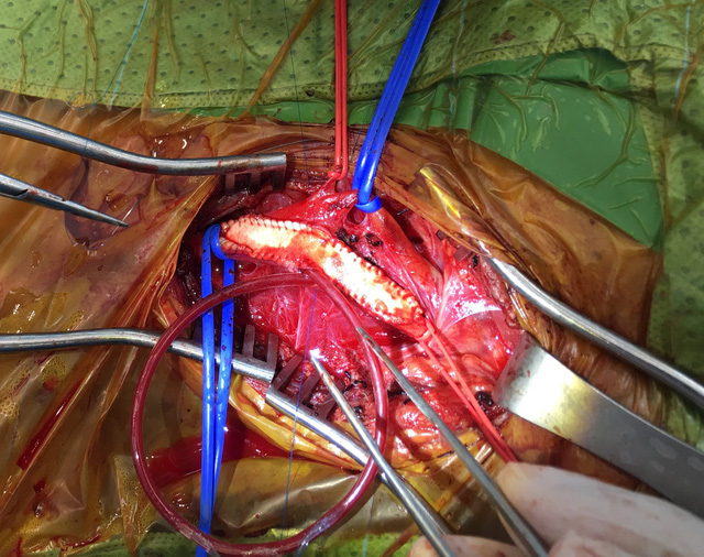 Phẫu thuật cho bệnh nhân bị hẹp động mạch cảnh - Ảnh 2.
