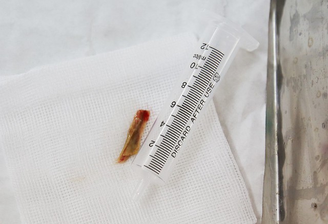 Gắp mảnh xương vịt nằm 1 tháng trong phế quản bệnh nhân - Ảnh 2.