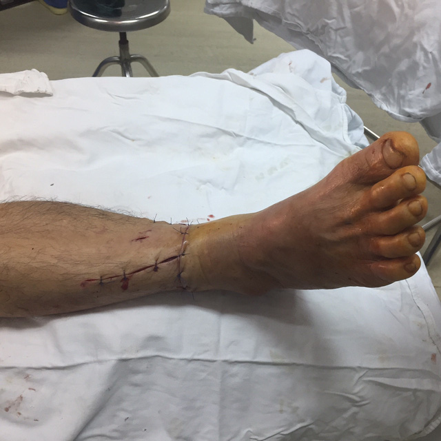 Nối lại cẳng chân cho bệnh nhân bị máy xén cỏ cắt đứt - Ảnh 2.
