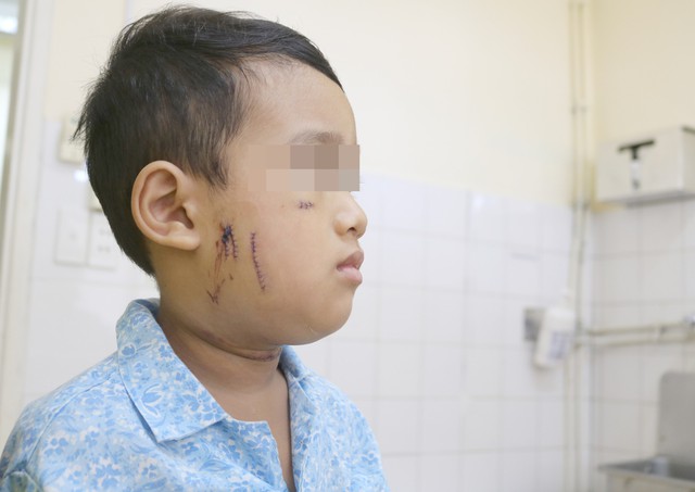 Bé 4 tuổi bị chó nhà tấn công nhập viện - Ảnh 1.
