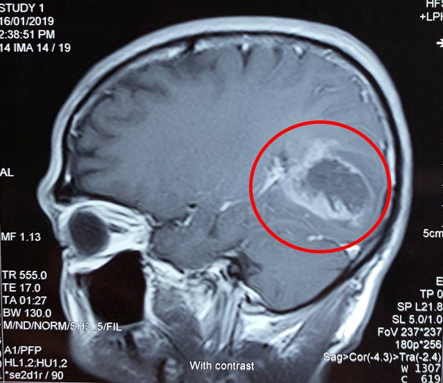 Đột ngột đau đầu, phát hiện khối u gây xuất huyết não  - Ảnh 1.