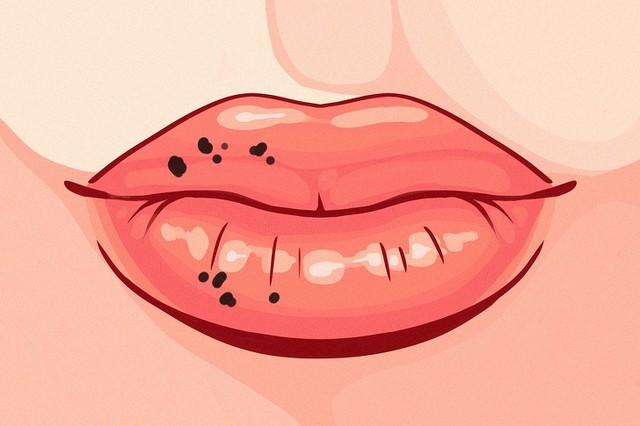 8 dấu hiệu của đôi môi tiết lộ tình trạng sức khỏe của bạn - Ảnh 8.