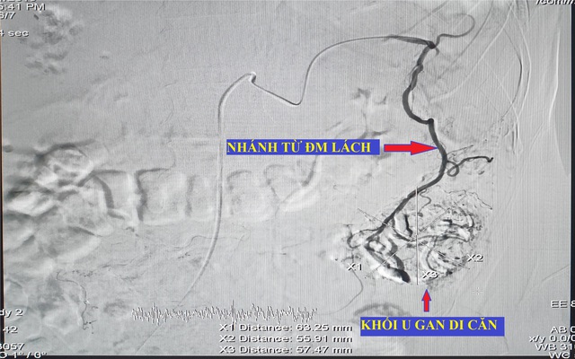 Lần đầu tiên can thiệp thành công ung thư gan di căn bằng nút động mạch hóa chất tại Đồng Bằng Sông Cửu Long - Ảnh 1.