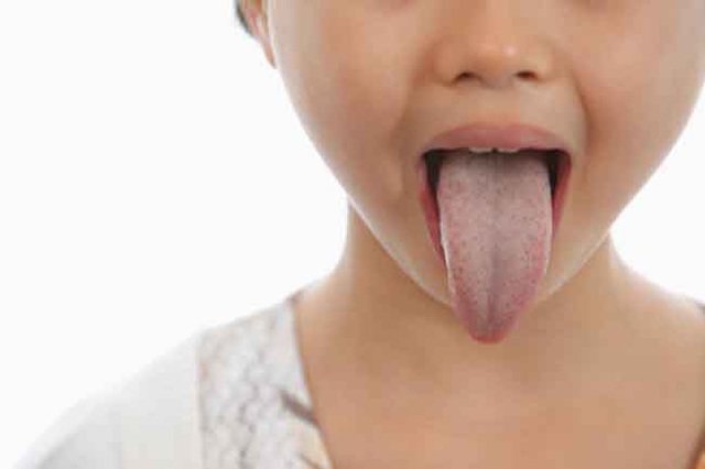 Nhận biết tình trạng sức khỏe qua các dấu hiệu của miệng - Ảnh 2.