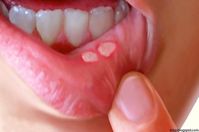 Nhận biết tình trạng sức khỏe qua các dấu hiệu của miệng - Ảnh 11.