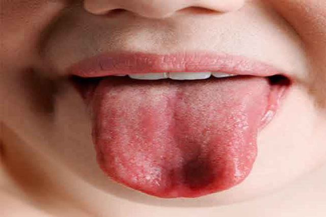 Nhận biết tình trạng sức khỏe qua các dấu hiệu của miệng - Ảnh 4.