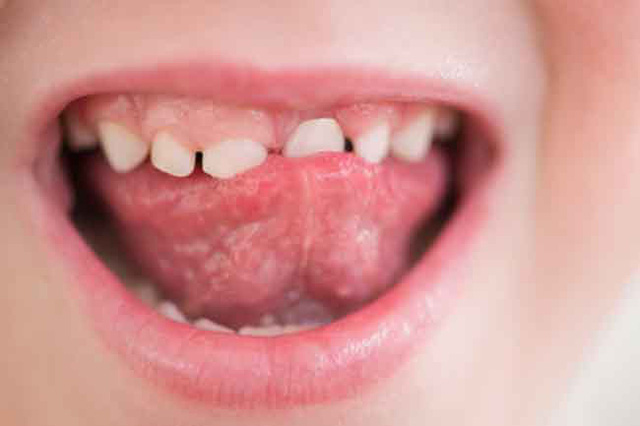 Nhận biết tình trạng sức khỏe qua các dấu hiệu của miệng - Ảnh 7.