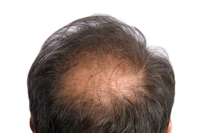 Nhận biết tình trạng sức khỏe của bạn qua mái tóc - Ảnh 8.