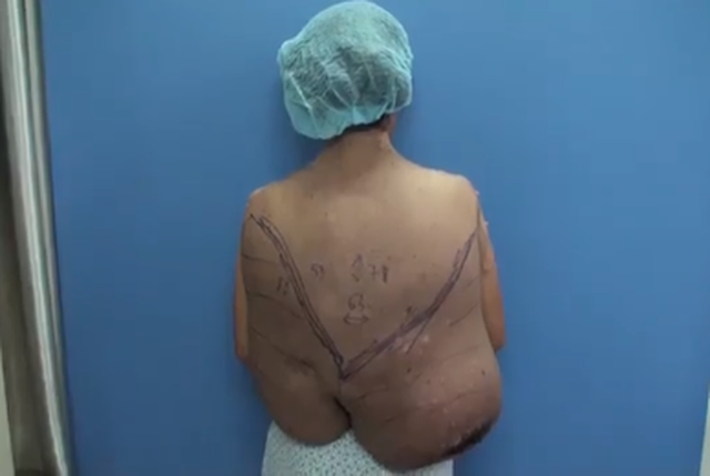 Người phụ nữ dân tộc Mường 15 năm mang trên mình khối u xơ thần kinh nặng 12kg - Ảnh 1.