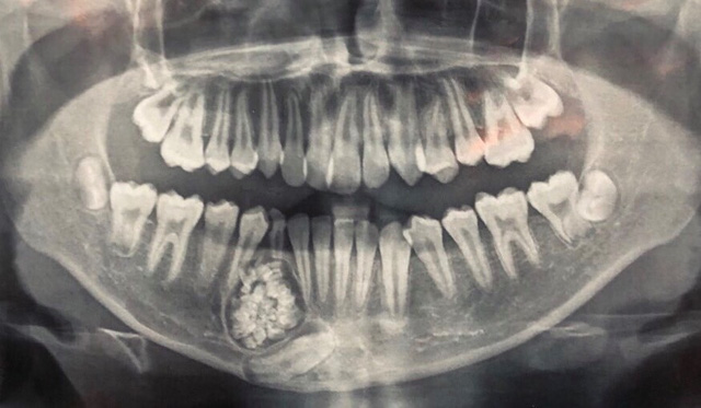 Ngỡ ngàng: Lấy gần 100 cái răng trong miệng thiếu niên 13 tuổi - Ảnh 1.