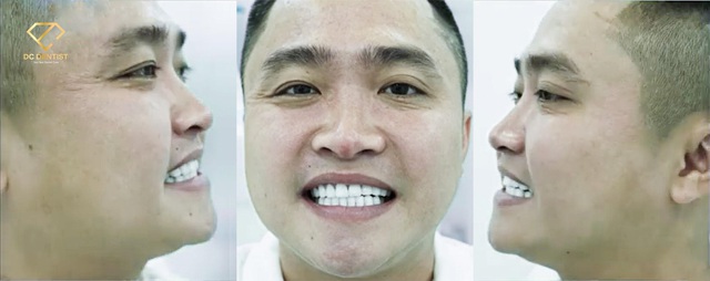 Hành trình tìm lại nụ cười tự tin bằng phương pháp phục hình Implant và bọc sứ Emax - Ảnh 5.