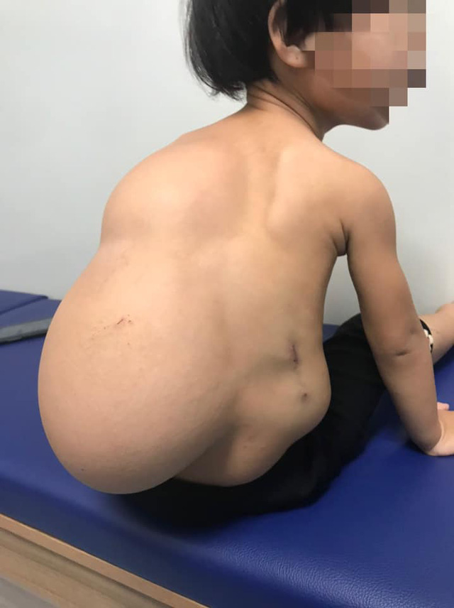 Giải thoát bé 2 tuổi khỏi khối u mỡ nặng 4kg trên lưng - Ảnh 1.