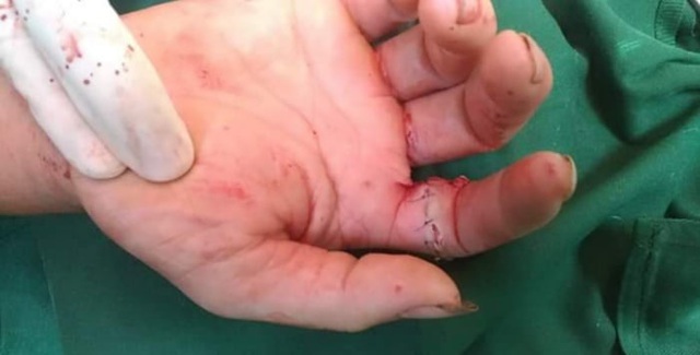 Nối thành công động mạch ngón tay trỏ bị máy cưa cắt đứt - Ảnh 1.