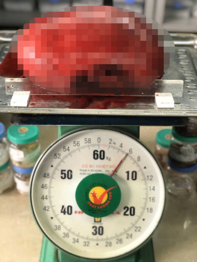 Ngỡ béo bụng, người phụ nữ không ngờ mang khối u nặng gần 6kg - Ảnh 1.