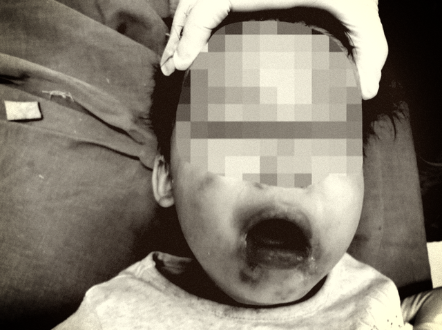 Cắn dây điện, bé gái 2 tuổi bị bỏng nặng vùng miệng - Ảnh 1.