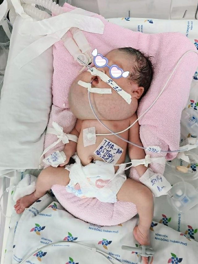 Hai bệnh viện Sản, Nhi phối hợp cứu bé sơ sinh mắc dị tật phức tạp - Ảnh 1.