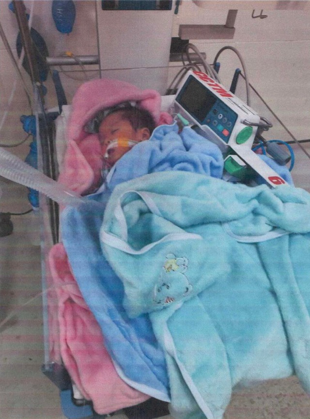 Em bé sinh đôi 2 tháng tuổi mắc bệnh tim bẩm sinh, không có tiền phẫu thuật - Ảnh 1.