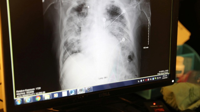Mỹ: Bệnh nhân tử vong sau khi được ghép phổi của người nhiễm virus SARS-CoV-2 - Ảnh 1.