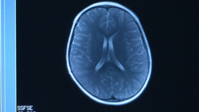 Giới khoa học tìm cách lý giải di chứng sương mù não ở bệnh nhân COVID-19 - Ảnh 1.